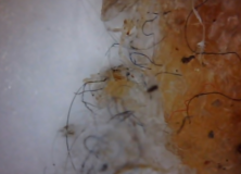 Morgellons Disease (Aspergillus Fumigatus) & V Fend Vs Noxafil (Pro) – Shingle, Lyme Disease,