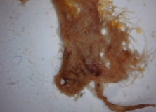 Morgellons Disease (Aspergillus Fumigatus) Update & V Fend Vs Noxafil – Shingle, Lyme Disease, eczema