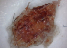 Morgellons Disease (Aspergillus Fumigatus) & V Fend Vs Noxafil (Pro) – Shingle, Lyme Disease