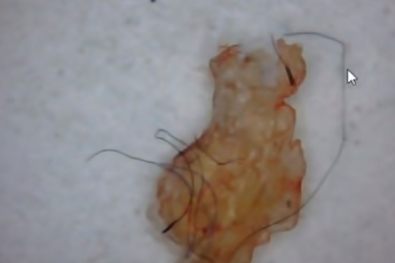Morgellons Pandemic 2