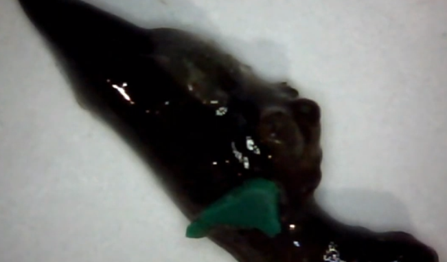 Morgellons disease