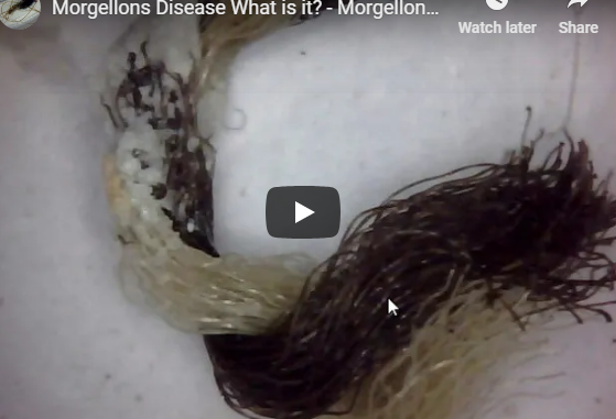 Morgellons