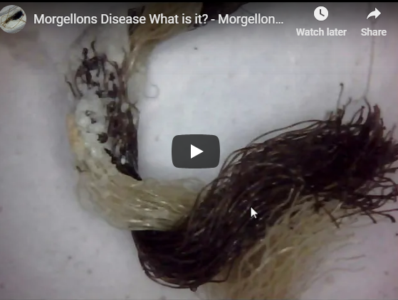 Morgellons Disease What is it? – Morgellons is A Fungi – More Update!