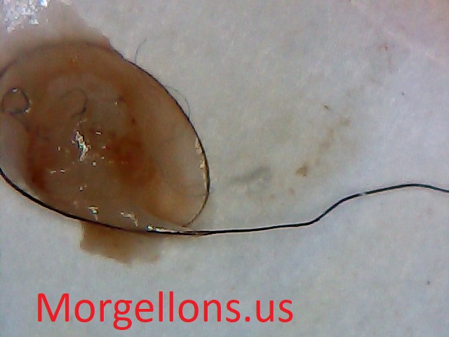 Shapes of Morgellons Disease The Silent Pandemic  –  fibromyalgia, Shingles & lyme disease