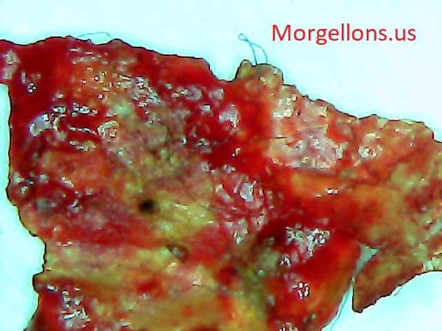 Morgellons Disease: The silent Pandemic – Aspergillus Fumigatus what is happening? – COVID 19