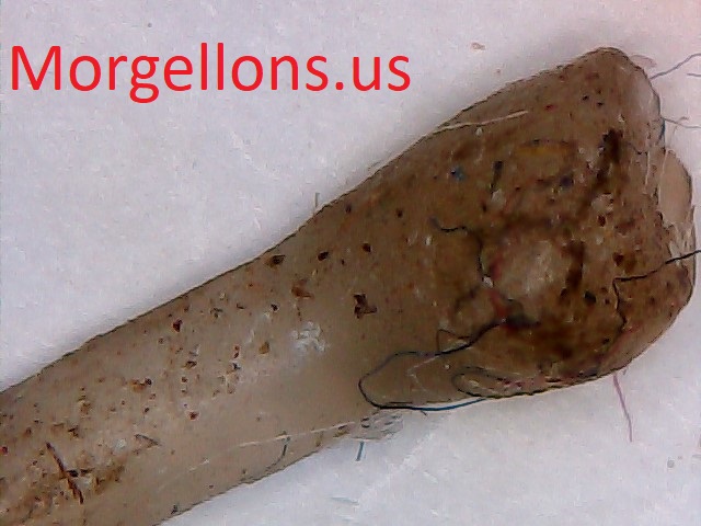 Aspergillus Fumigatus A living hell – Morgellons Disease the silent Pandemic