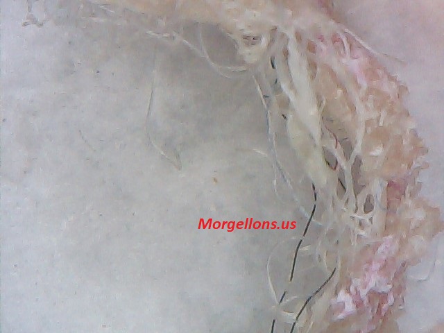 COVID 19 Is morgellons Disease: The Silent Pandemic, Doctors and scientist ignore it