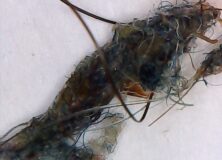 Aspergillus Fumigatus coming off the body – Morgellons Disease: The Silent Pandemic