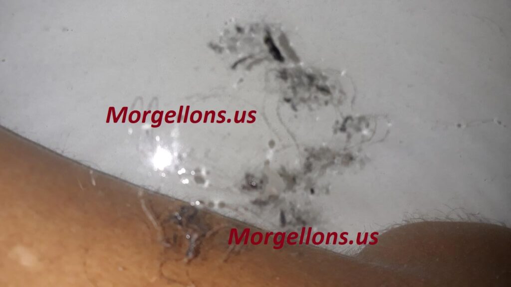 Aspergillus Fumigatus coming off the body - Morgellons Disease: The Silent Pandemic