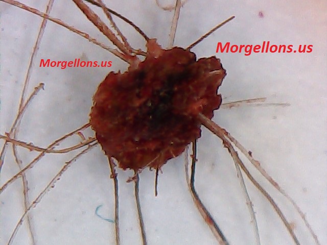 Aspergillus Fumigatus is the real pandemic - Morgellons Disease: The silent Pandemic!!!