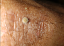 Dry Skin Why? – Morgellons Decease – The silent pandemic – Aspergillus Fumigatus