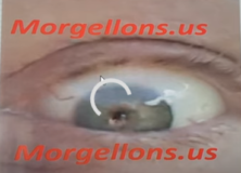 My Mom Passed sorry for delay – Morgellons Decease – The silent pandemic – Aspergillus Fumigatus