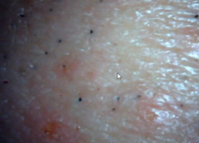 Skin Disease What is it Really? – Morgellons Disease – The Silent Pandemic Aspergillus Fumigatus