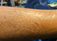 Skin Problem Why? – Morgellons Disease The Silent Pandemic – Aspergillus Fumigatus