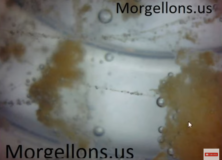 What Is It Really? – Morgellons Disease: The Silent Pandemic – Aspergillus Fumigatus