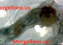 Morgellons is a fungi living on Body – Morgellons Disease The Silent Pandemic Aspergillus Fumigatus