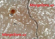 Morgellons Disease is not a fungi? – So They say! – The Silent Pandemic Aspergillus Fumigatus