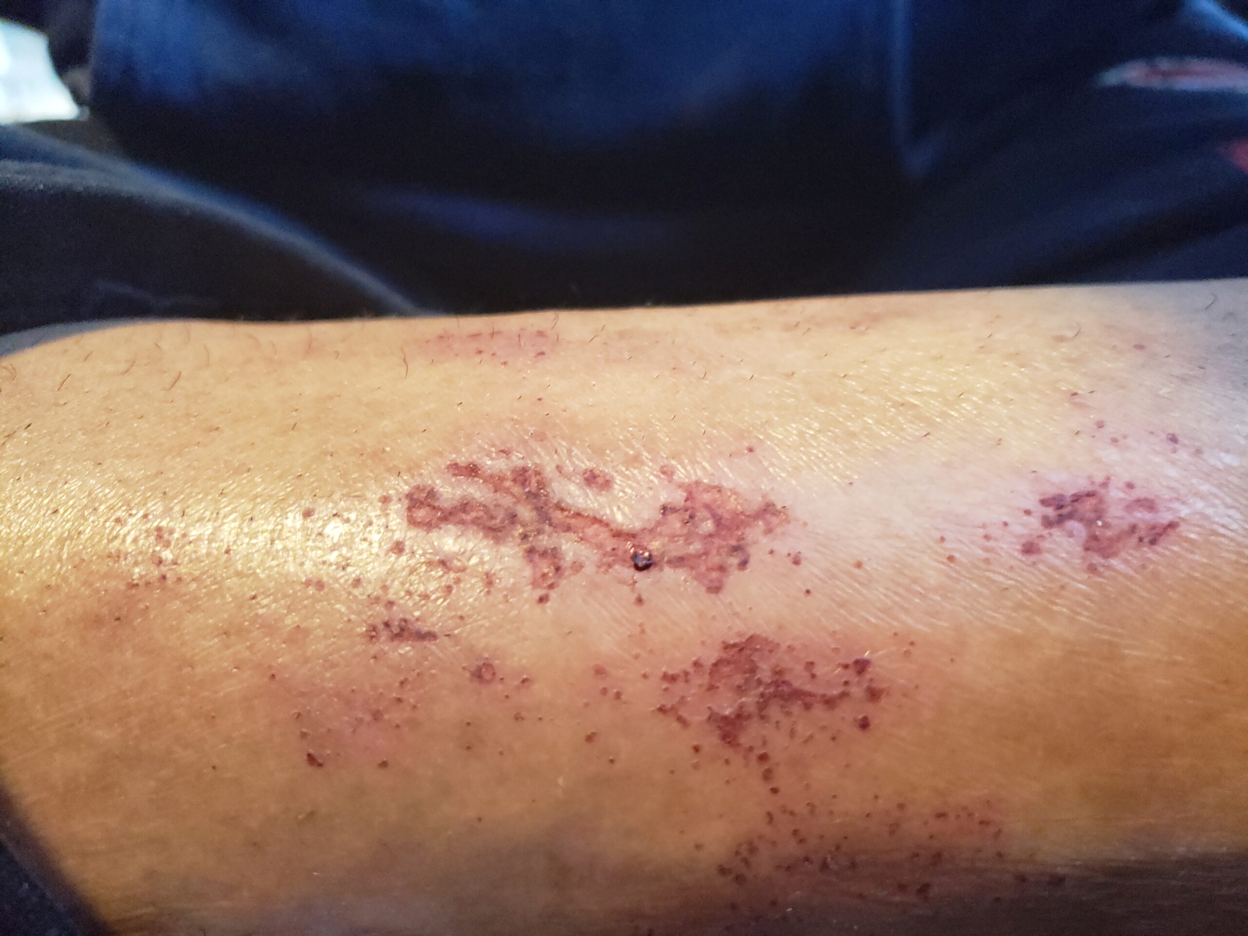Peeling skin & Why? – Morgellons Desease – The silent pandemic – Aspergillus Fumigatus